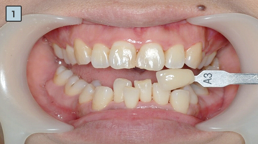 歯の黄ばみをホワイトニングにより詰め物の形態不良をコンポジットにて修復したケース 安城市の歯医者さん杉浦歯科医院